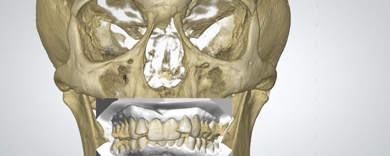 sovrapposizione cranio modelli dentali digitali studio dentistico motta jones rossi milano centro